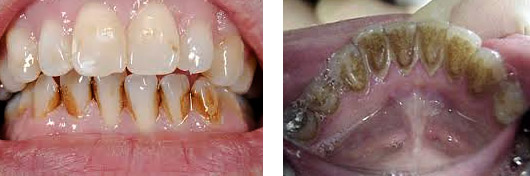 Externe Zahnverfärbungen, durch eine professionelle Zahnreinigung entfernbar