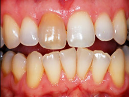 Zahnverfärbung nach Wurzelbehandlung