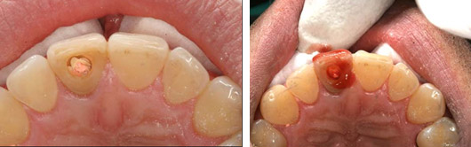 Blick auf die Wurzelfuellung von hinten / Bleaching Gel im Zahn