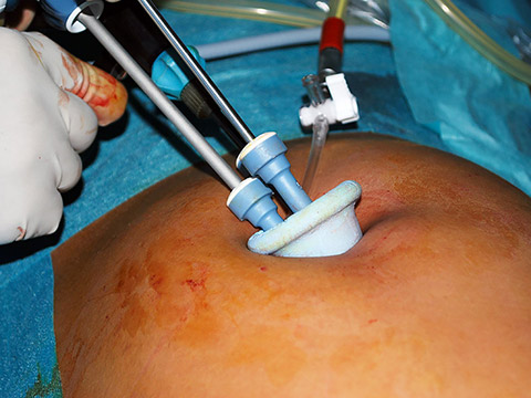 Minimal-invasive Operation