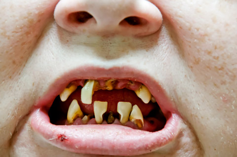 Schlechte Zähne