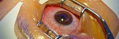 Augenlasern bei Alterssichtigkeit mit Presbyond